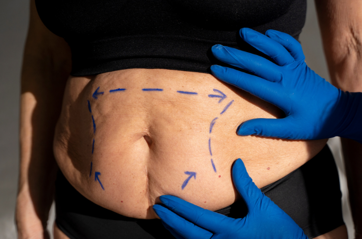 Liposuction