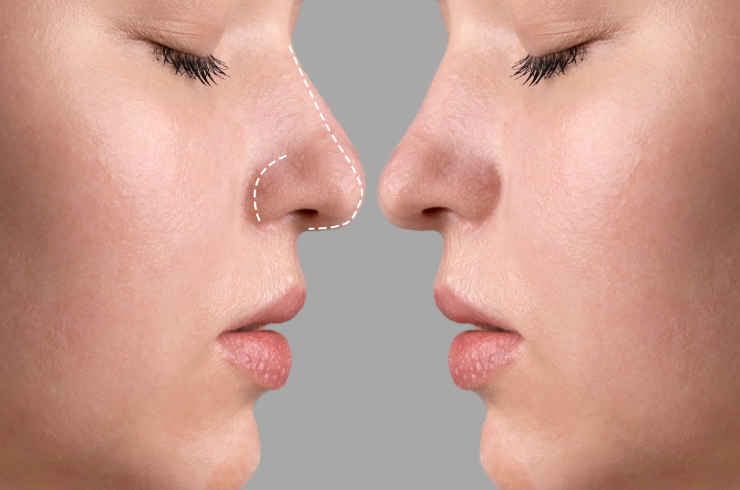 Rhinoplasty
