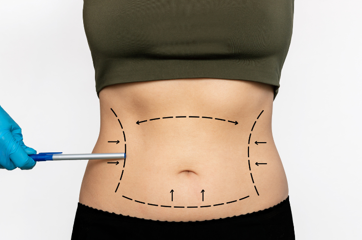 Abdominoplasty