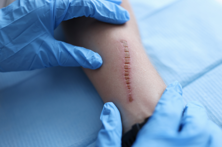 Scar Reduction